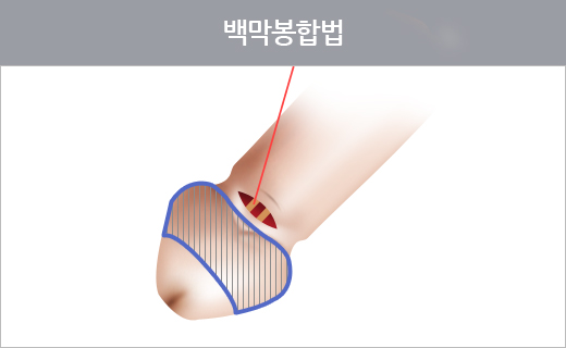 백막봉합법