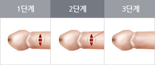 음경배부신경차단술 수술단계