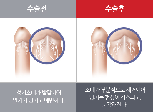 소대차단술 전후