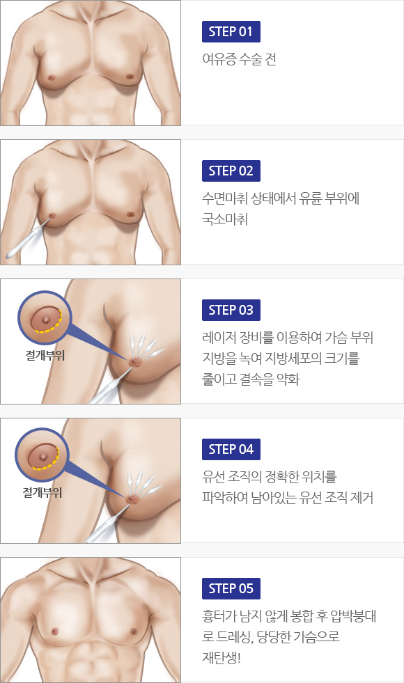 여유증 치료 방법