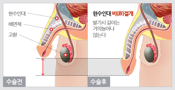 리드엠의원의 현수인대 비절개식 길이연장