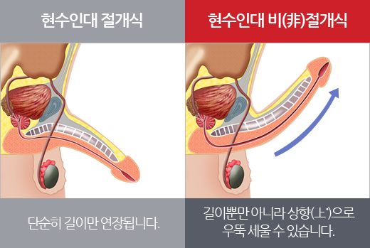 리드엠의원의 현수인대 비절개식 길이연장