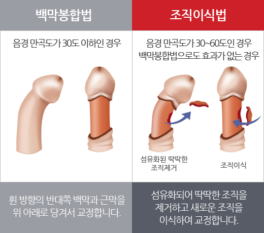 음경만곡증의 치료